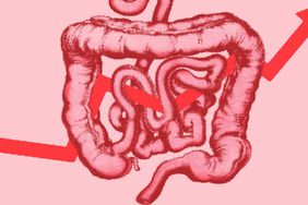 Rising-Rates-of-Colorectal-Cancer-In-Young-Adults-GettyImages-152408132-