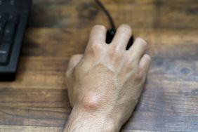 person with sebaceous cyst on their hand