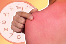 A man with reddened, itchy skin after sunburn. Skin care and protection from the sun's ultraviolet rays.
