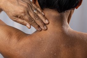 person experiencing tinea versicolor patches on their back