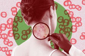 What-Is-a-Meningitis-Rash-GettyImages-925863720