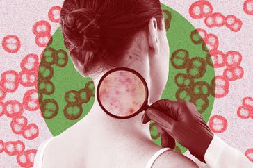 What-Is-a-Meningitis-Rash-GettyImages-925863720