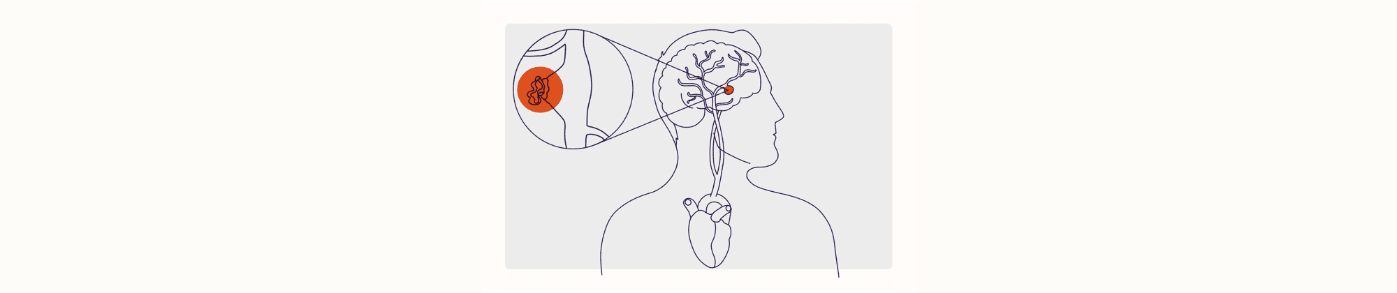 Health Overview Illustration - Aneurysm