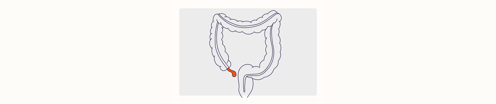 Health Overview Illustration - Appendicitis