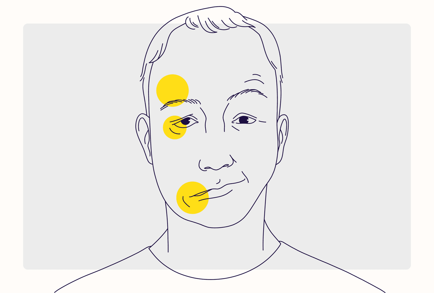Health Overview Illustration - Bell's Palsy
