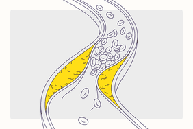 Health Illustration Overview - Coronary Artery Disease