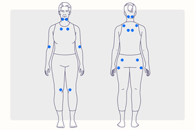 Health Overview Illustration - Fibromyalgia