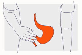 Health Overview Illustration - Gastroesophageal Reflux Disease (GERD)