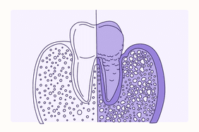 Health Overview Illustration - Gingivitis