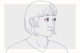 Health Photo Composite - Graves' Disease