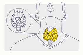 Health Illustration Overview - Hashimotoâs Disease