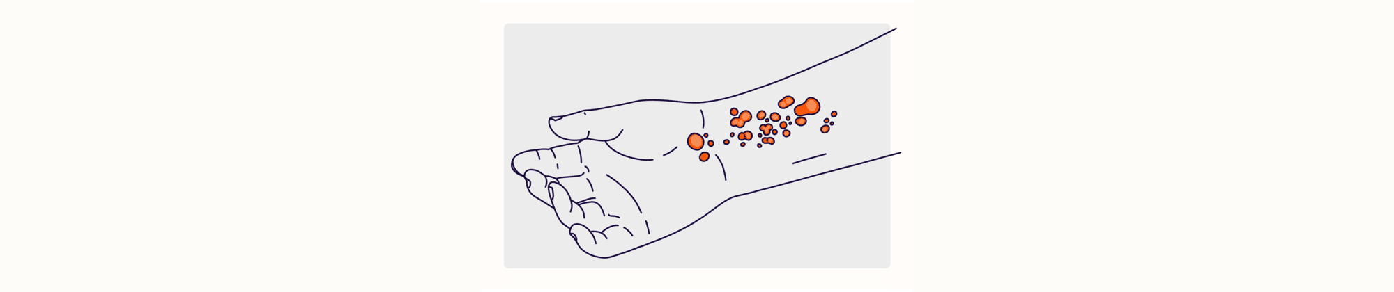 Health Overview Illustration - Hives