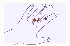 Health Overview Illustrations - HPV