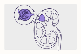 IgA Nephropathy (Berger's Disease) Illustration