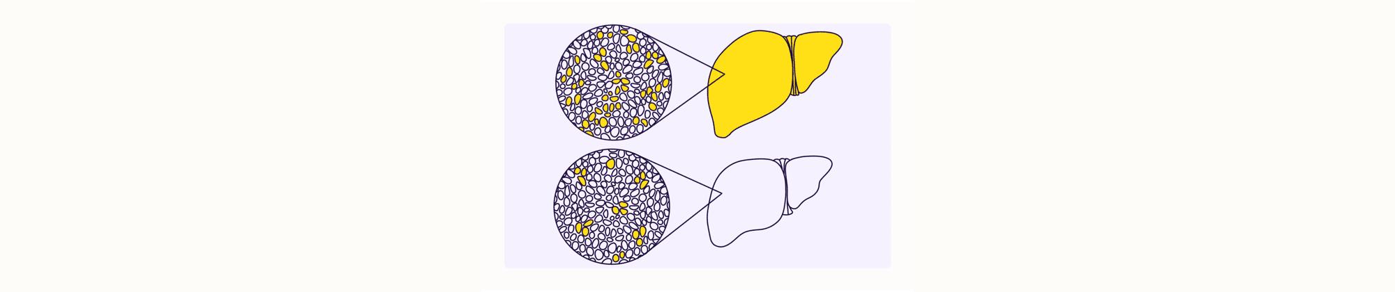 Health Overview Illustration - Liver Disease