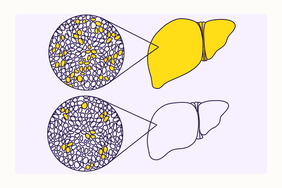 Health Overview Illustration - Liver Disease