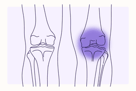 Health Overview Illustration - Osteoarthritis