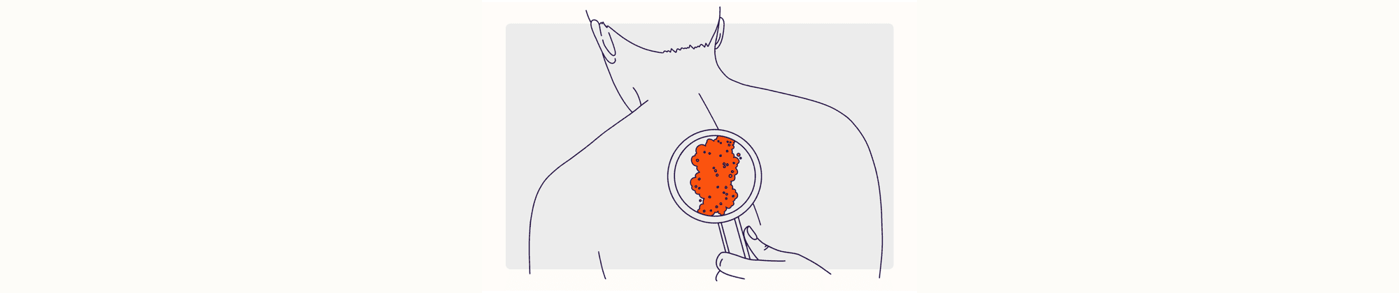 Health Overview Illustration - Skin Infections