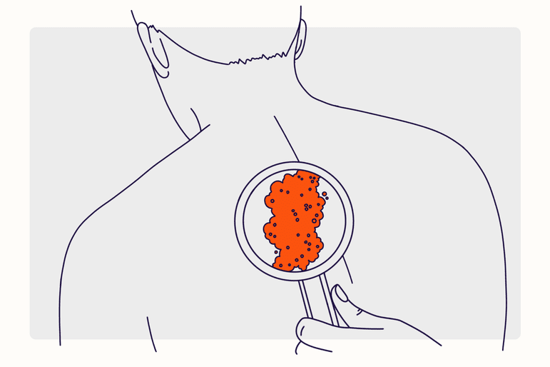 Health Overview Illustrations - Skin Infections