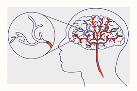 Health Overview Illustration - Stroke