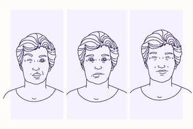 Health Overview Illustration -Tardive Dyskinesia