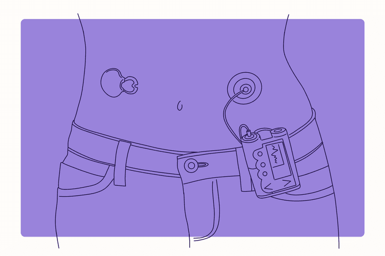 Illustration of Type 1 Diabetes