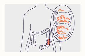 Health Overview Illustration - Ulcerative Colitis